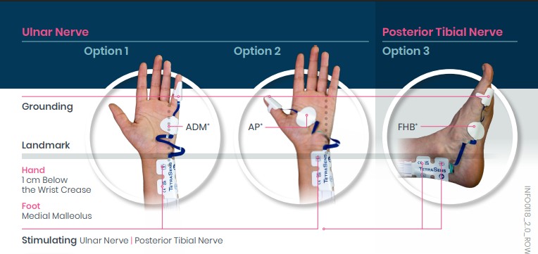 Three diagrams show electrode placements on hands for ulnar nerve and foot for posterior tibial nerve stimulation.