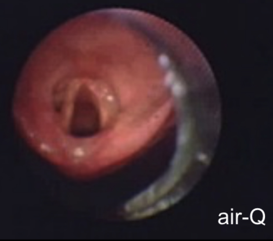 Endoscopic view of human vocal cords and airway, with a medical airway device visible on the right. Text "air-Q" in corner.