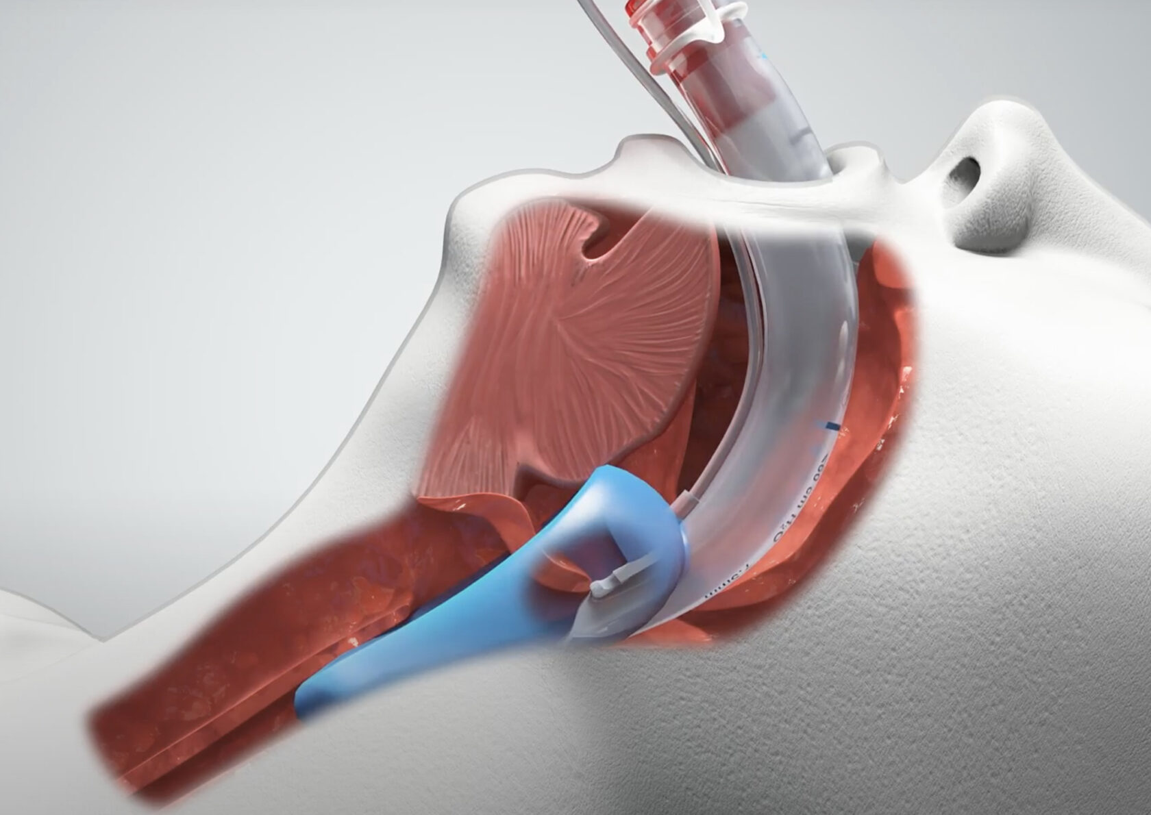 Medical illustration of a breathing tube inserted through the mouth into the airway of a patient lying on their back.